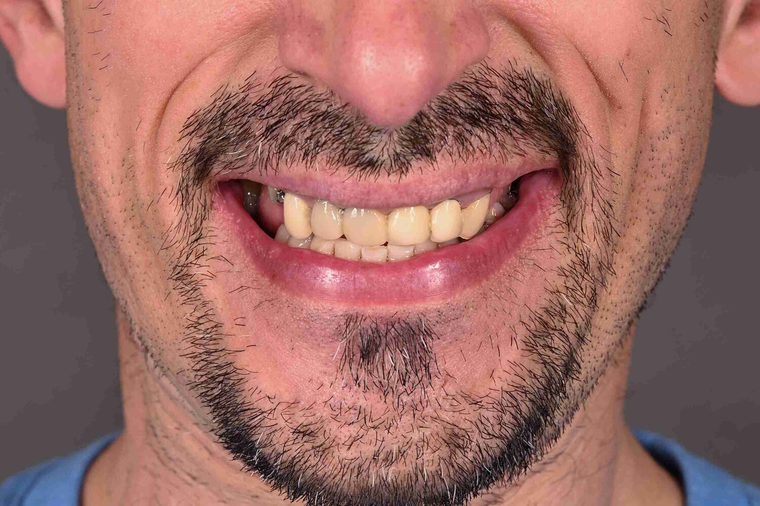 Pacient Clinica Dr. Alin Odor - Rezultat Implantologie